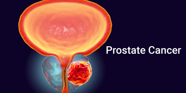 Prostate cancer diagnoses set to double by 2040 particularly in low income countries – Study
